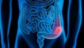 Anvisa aprova terapia para o tratamento de câncer colorretal metastático