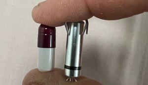 Menor marca-passo do mundo é implantado em paciente da Santa Casa de Maceió