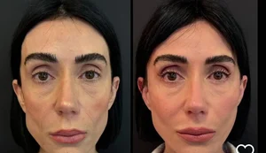 Jornalista alagoana Michelle Barros remove preenchimentos do rosto e diz se sentir mais natural