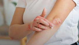 Dia Mundial da Psoríase reforça que a doença não é contagiosa e tem tratamento