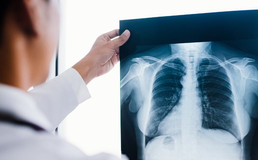 Saiba mais sobre a Fibrose Cística: condição genética que afeta pulmões e sistema digestivo