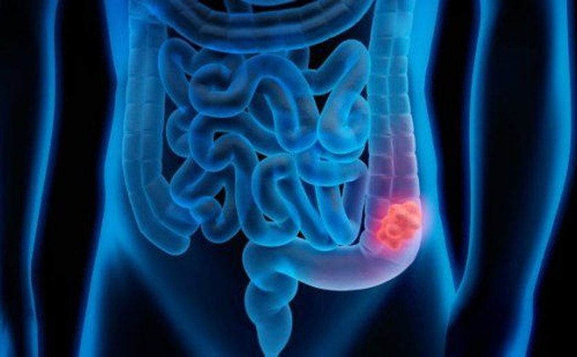 Anvisa aprova terapia para o tratamento de câncer colorretal metastático