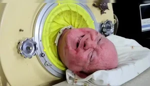 Morre homem que viveu 70 anos em 'pulmão de ferro'