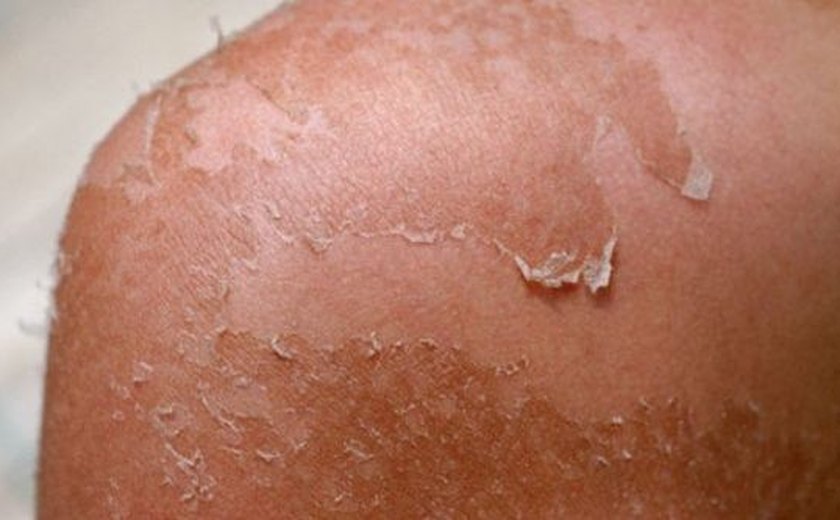Fuja da descamação da pele após exposição ao sol