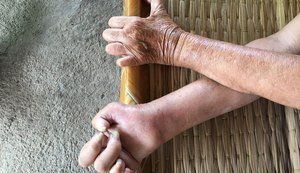Instituto alerta sobre a importância do diagnóstico e tratamento da hanseníase no Brasil