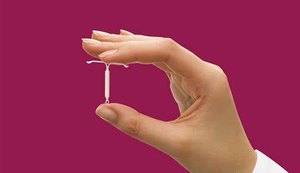 DIU: saiba mais informações sobre o método contraceptivo