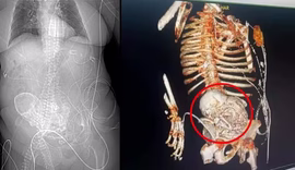 Idosa de 81 anos carregava feto calcificado há cinco décadas