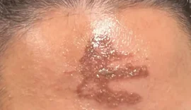 Fiéis sofrem ardência, reação alérgica e queimadura de 2º grau após contato com cinzas em missa