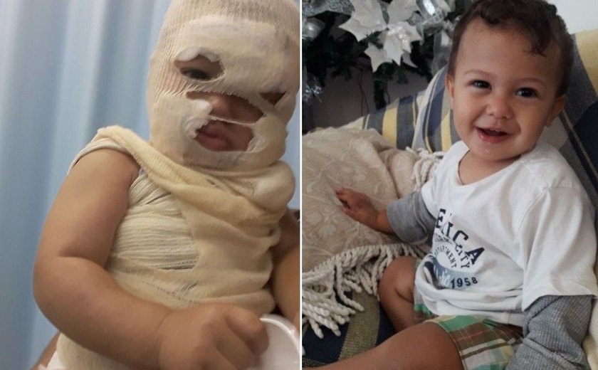 Bebê tem rosto desfigurado por água fervendo e pais fazem apelo: 'Desespero'