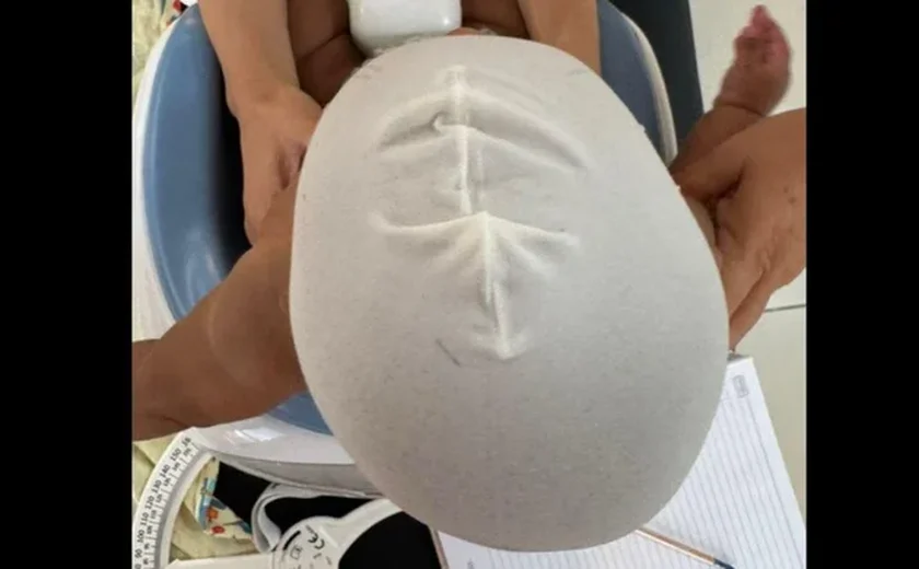 Pais de bebê pedem ajuda para custear tratamento de Plagiocefalia muito severa que custa mais de R$ 15 mil