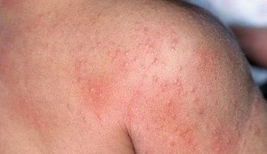 Doenças de verão: conheça as mais comuns e saiba como se prevenir