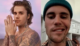Justin Bieber aparece com rosto paralisado e cancela shows