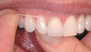 Fio dental é a recomendação para uma higiene completa