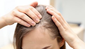 Queda de cabelo: o sintoma inusitado da Covid-19