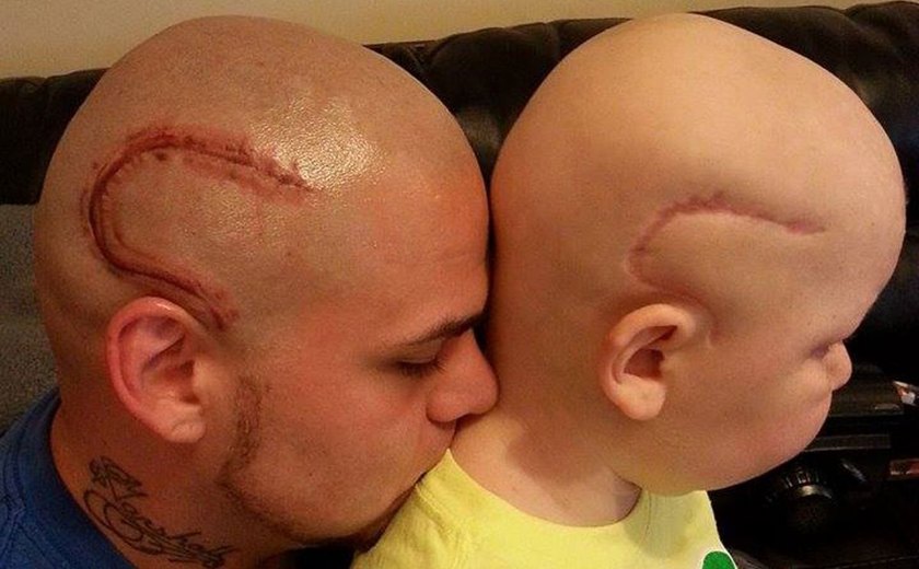 Menino que inspirou pai a fazer tatuagem imitando sua cicatriz morre nos EUA