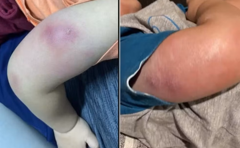 Menino de um ano é internado com infecção grave após tomar vacinas em posto de saúde em Maceió