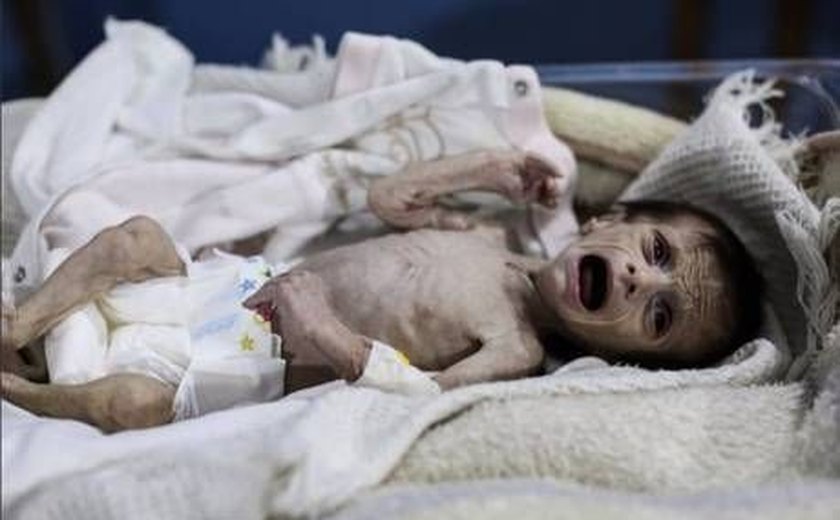 Imagem de bebê desnutrida mostra necessidade de auxílio a crianças na Síria