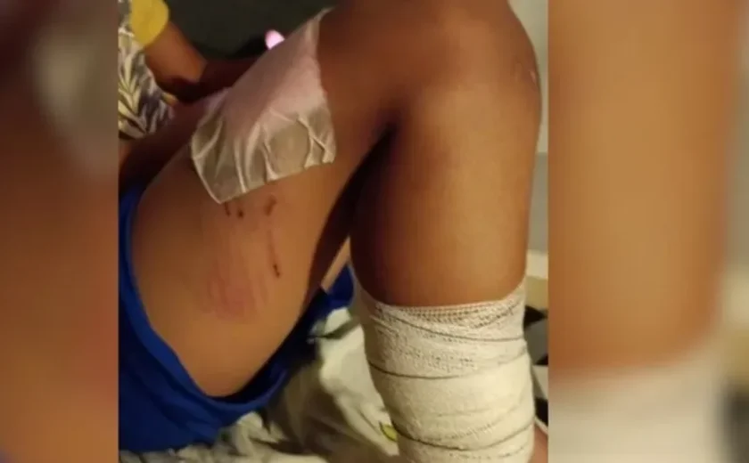 Crianças ficam feridas após ataque de pitbull em condomínio de Monte Mor