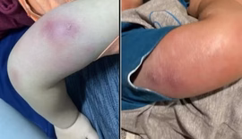 Menino de um ano é internado com infecção grave após tomar vacinas em posto de saúde em Maceió