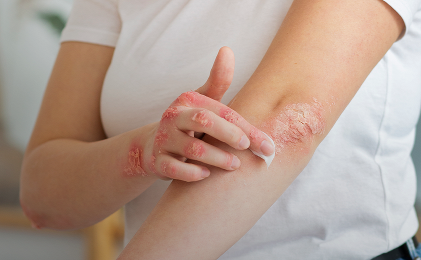Dia Mundial da Psoríase reforça que a doença não é contagiosa e tem tratamento