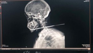 Homem tenta atravessar fronteira entre Guiana e Brasil e tem pescoço perfurado por flecha