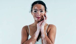 Vitiligo: por que pele da participante do BBB não ficou toda branca como Michael Jackson?