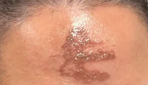 Fiéis sofrem ardência, reação alérgica e queimadura de 2º grau após contato com cinzas em missa