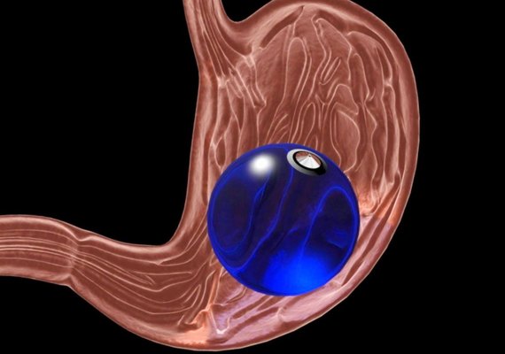 As 6 principais dúvidas sobre o balão intragástrico