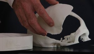Pesquisadores brasileiros desenvolvem tecnologia de reconstrução craniana