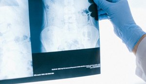 Tuberculose: diagnóstico precoce e tratamento adequado são essenciais