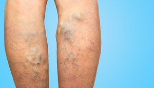 Você sabia que homens também têm varizes?