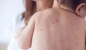 Infectologista alerta para a atualização das vacinas na prevenção contra a meningite