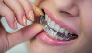 Sorrir virou tendência: mercado de ortodontia estética vive seu melhor momento