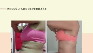Diástase: afastamento do músculo reto abdominal tem tratamento sem cirurgia
