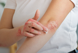 Dia Mundial da Psoríase reforça que a doença não é contagiosa e tem tratamento