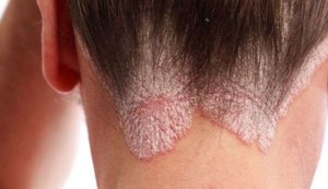 Dia Mundial da Psoríase: Diversos mitos ainda rondam a doença, afirma dermatologista