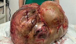 Tumor com cerca de 46 kg é retirado de mulher em cirurgia de emergência em Itaperuna, no RJ