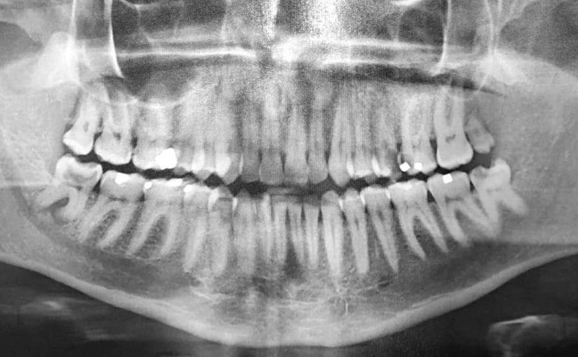 Exame odontolegal identifica corpo de homem encontrado morto em Palmeira dos Índios