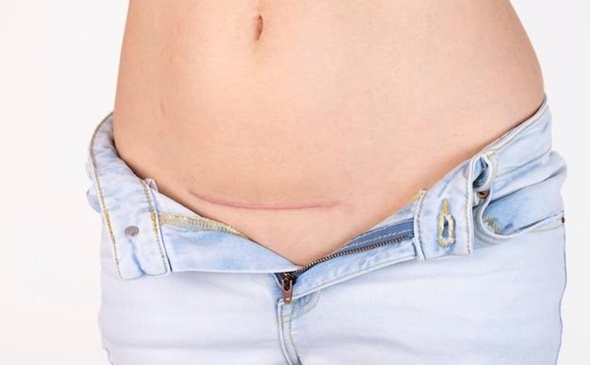 Cesárea aumenta risco de câncer de placenta após mola gestacional
