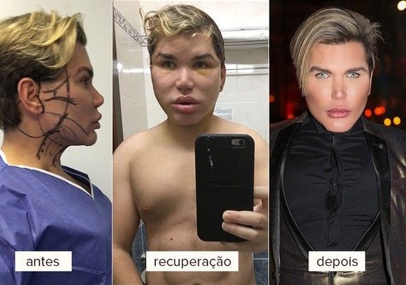 Rodrigo Alves, o Ken Humano, refaz rosto e admite que 'não aceita envelhecer'