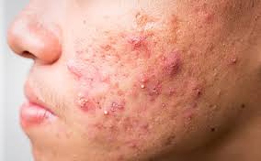 Acne em diferentes fases da vida: entenda