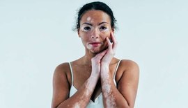 Vitiligo: por que pele da participante do BBB não ficou toda branca como Michael Jackson?