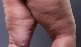 Lipedema: o que é a doença frequentemente confundida com obesidade e celulite