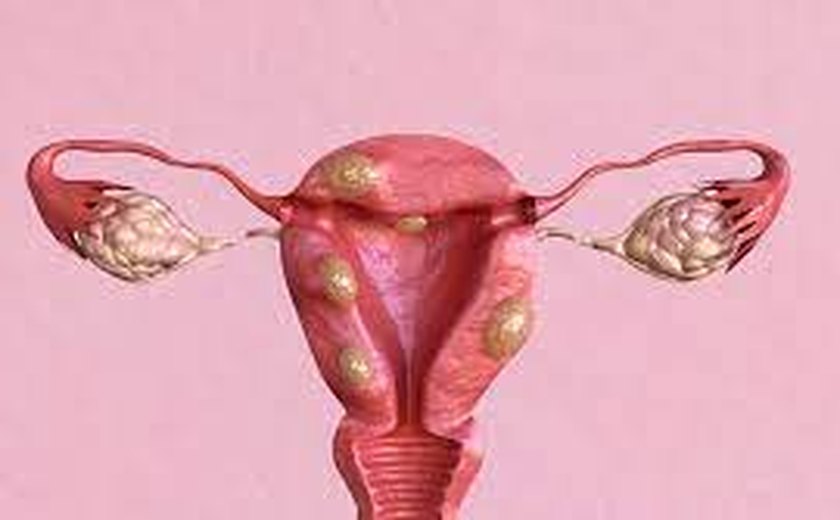 Estudo mostra que 80% das mulheres com idade fértil possuem miomas uterinos