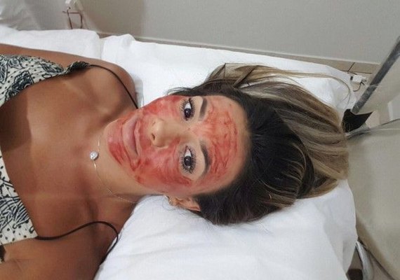 Ex-BBB Fabiana Teixeira faz tratamento com sangue no rosto
