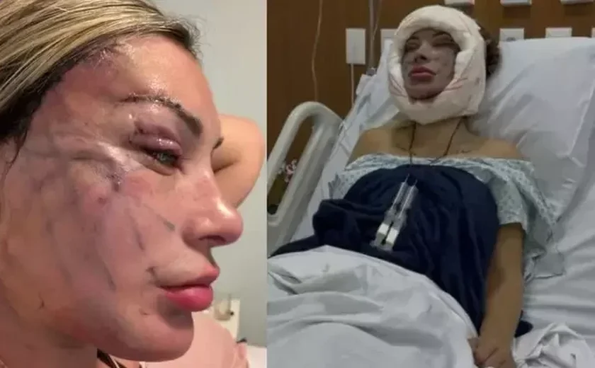 23 outra vez? Médicos reagem após Andressa Urach realizar cirurgia de rejuvenescimento