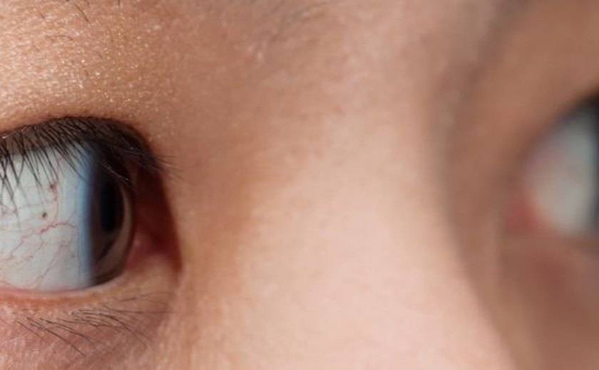Descolamento de retina atinge 1 a cada 10 mil habitantes e pode cegar
