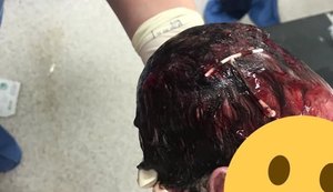Viralizou: Bebê nasce com DIU preso no cabelo