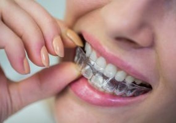 Sorrir virou tendência: mercado de ortodontia estética vive seu melhor momento