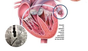 Cardiologia da Santa Casa de Maceió inova com próteses que podem evitar AVC